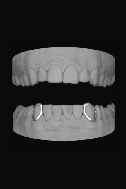 2 x Canine Windows (Lower)