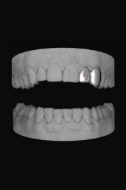 Bolt Lateral & Canine