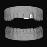 Lateral & Bar