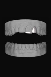 Lateral & Bar