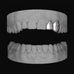 Lateral & Bolt Canine