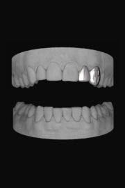 Lateral & Bolt Canine