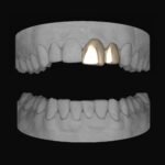 Front Tooth & Lateral