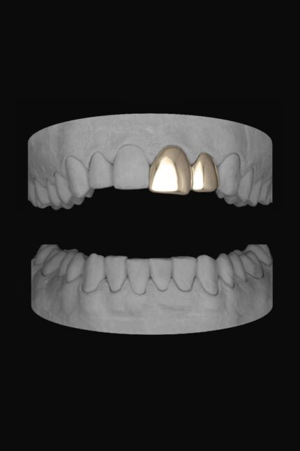 Front Tooth & Lateral